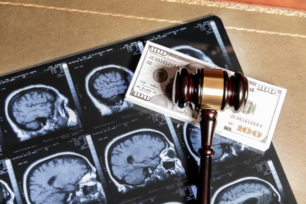 Are personal injury settlements taxable in California?